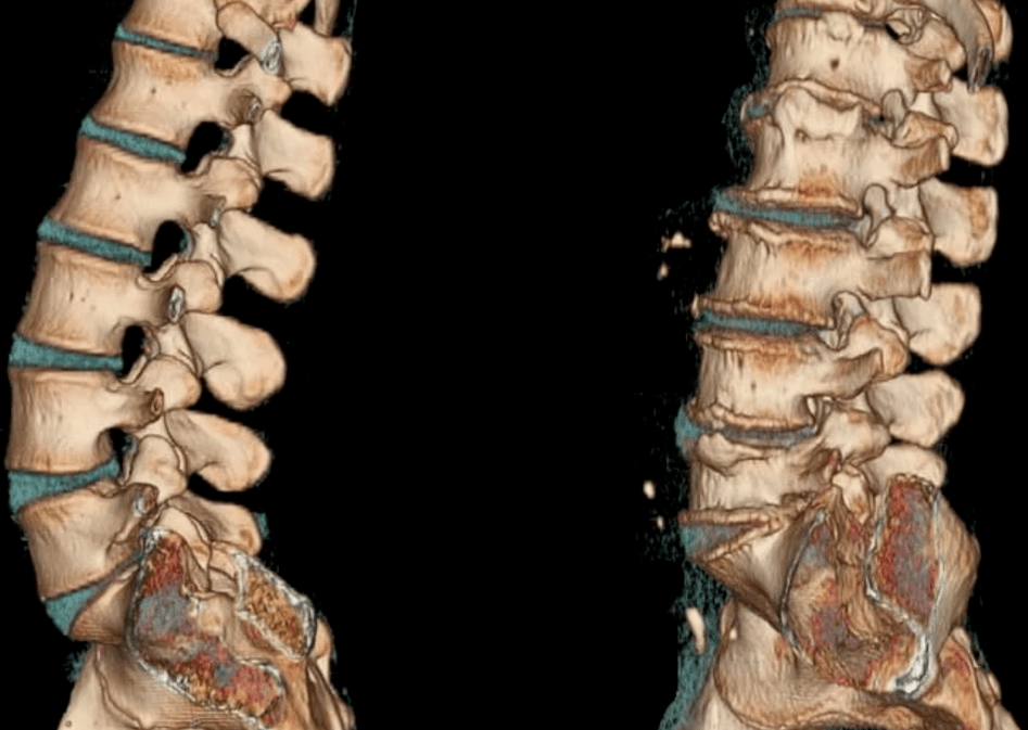 osteocondrosi