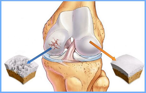 Articolazione del ginocchio normale e affetta da artrosi