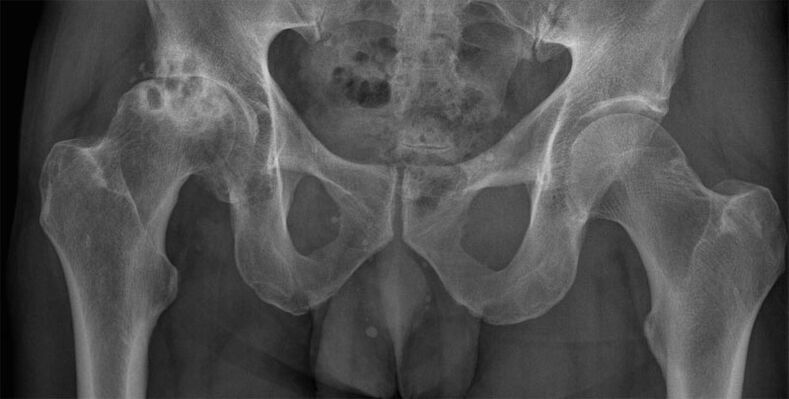 Artrosi deformante dell'articolazione dell'anca ai raggi X