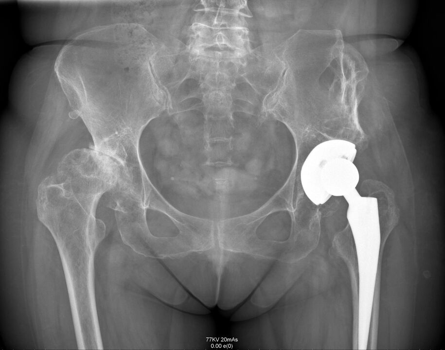 Radiografia dell'articolazione dell'anca dopo l'artroplastica