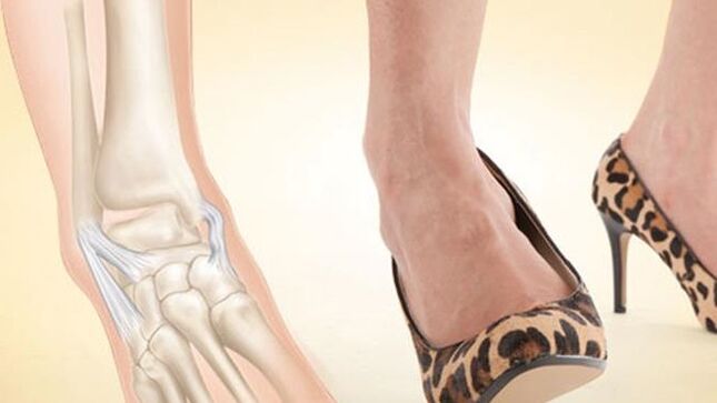 indossare scarpe con tacco come causa di artrosi della caviglia