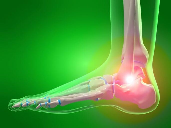 infiammazione dell'articolazione della caviglia con artrosi