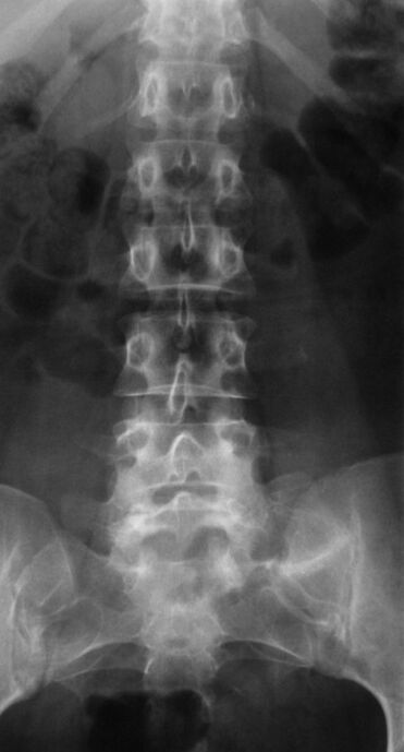 Per diagnosticare l'osteocondrosi lombare, viene eseguita la radiografia