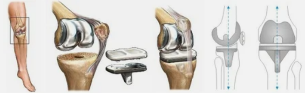Artroplastica per esempio il ginocchio